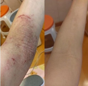 排寒人自癒分享|患有濕疹意外地令我獲益良多